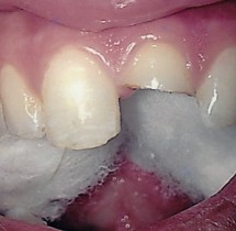 central-incisor-fractured