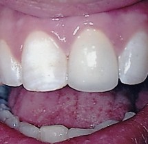 central-incisor-restored-with-all-ceramic-crown