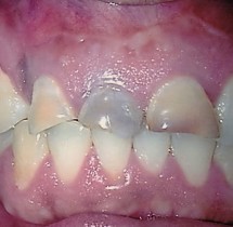 discoloured-incisors